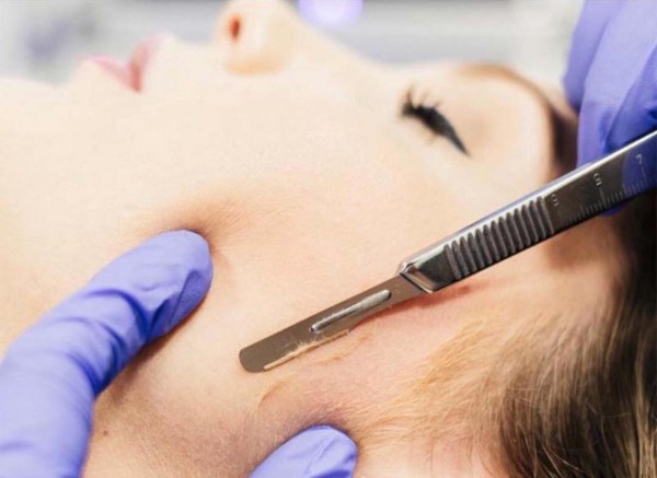 Imagem do serviço de Dermaplaning